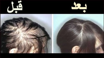 حيلة سحرية لإنبات الشعر في أسبوعين فقط