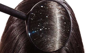 لا تتنازلي عن أناقتك .. أفضل خلطات طبيعية منزلية للتخلص من القشرة