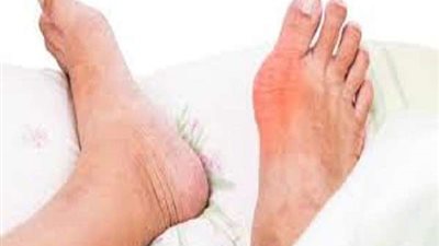 ما هي أسباب النقرس و كيف يتم علاجه