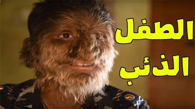 أطباء يتوصلون لعلاج الطفل المستذئب بالهند