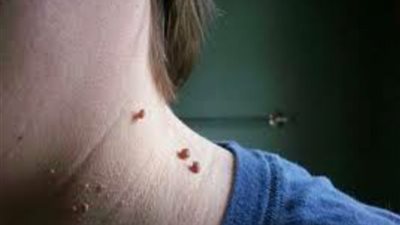 استشاري تجميل: 3 طرق للتخلص من الزوائد الجلدية