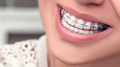 أبرزها الغسول والفرشاة.. 6 نصائح للحفاظ على تقويم الأسنان