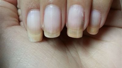 حوار.. طبيب: لون الأظافر مؤشر لحالة الجسم.. وهذه أبرز مخاطرها