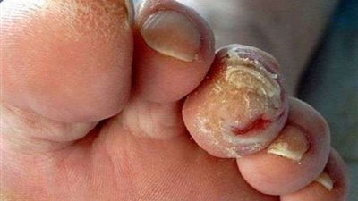 أستاذ جراحة: هذه أعراض القدم السكري.. و3 أنواع للغيارات الطبية لعلاجه