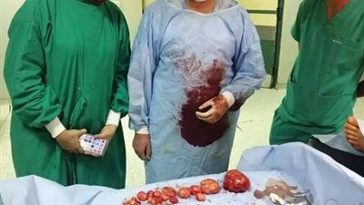 لأول مرة.. استئصال 22 ورم ليفي من رحم سيدة ببني سويف