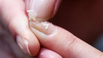 أستاذ جراحة يكشف الحالات المرضية المسببة لتكسر الأظافر.. وهذه تقنيات العلاج