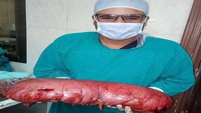 استئصال ورم يزن 3 كيلو جرام من قولون سيدة بمستشفى بطنطا