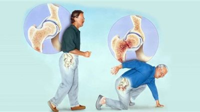 في يومه العالمي.. كل ما تريد معرفته عن هشاشة العظام