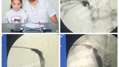 فريق طبي بجامعة أسيوط ينقذ حياة طفلة باستخدام القسطرة التداخلية