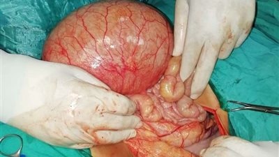 استئصال ورم يزن 10 كيلو جرام من بطن سيدة بمطروح