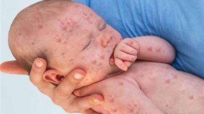 الحصبة.. كل ماتريد معرفته عن المرض قبل انطلاق حملة التطعيم ضده