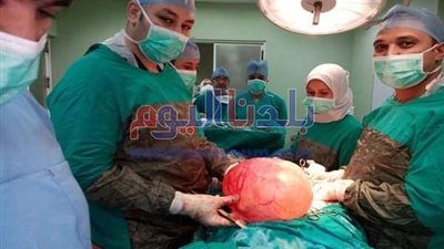 استئصال ورم يزن 25 كيلو من رحم سيدة بالتأمين الصحي في بني سويف