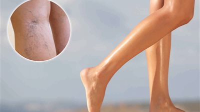 وليد الدالى يوضح أهم مزايا علاج دوالى الساقين بالليزر