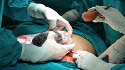 بزنس الولادة القيصرية ناقوس الخطر الذي يدق البيوت المصرية