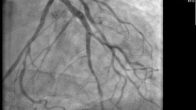 إجراء 3247 عملية قلب مفتوح وقسطرة علاجية ضمن 