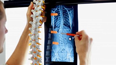 عاجل| إصلاح إعوجاج حاد وتشوهات بالعمود الفقري لشاب بالإسماعيلية