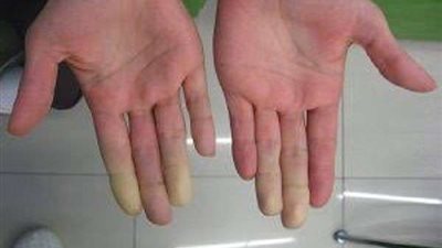 طبيب: هذه أسباب عدم وصول الدم للأطراف في الشتاء