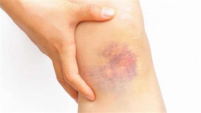 استشاري: 8 أعراض تكشف عن سرطان الدم.. وهذه طرق العلاج