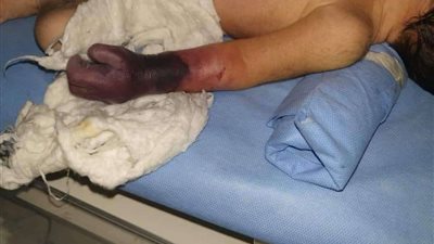 بعد تداول حالتها.. الحكومة تستجيب لشكوى علاج طفلة أصيبت بانسداد في الشرايين