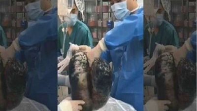 شاهد.. ماذا يفعل التبغ في رئتيك بعد مرور 30 عام؟