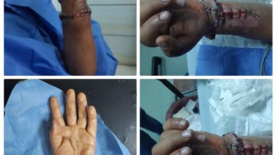 جامعة أسيوط تنجح في زرع يد شاب بعد بترها بالكامل بحادث سيارة