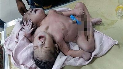 رأسين و3 أذرع.. ولادة طفل هندي تثير ذعر الأطباء (فيديو)