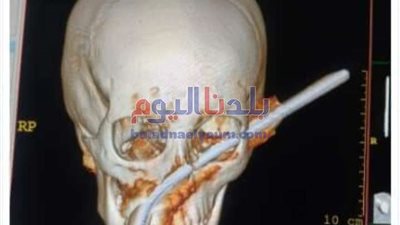 أطباء مستشفي المنيا الجامعي ينقذون طفل بعد نفاذ سيخ حديد بوجهه