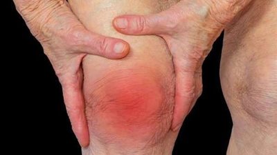 اكتشافه يحميك من السرطان.. تعرف على التهاب المفاصل الروماتويدي وكيفية تجنبه