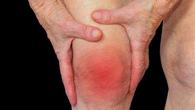 طبيب: 5 أسباب وراء التهاب المفاصل الروماتويدي.. وهذه طرق الوقاية والعلاج