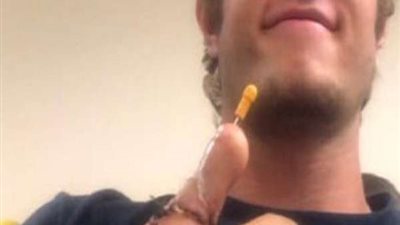 فريدة من نوعها.. تعرف على أغرب عملية جراحية