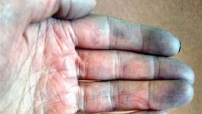 طبيب يكشف عن أسباب تغير لون الأطراف في الشتاء