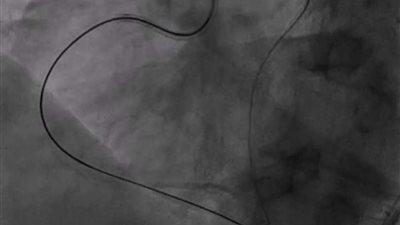 فريق طبي بمستشفى القلب الجامعى بأسيوط  ينجح فى علاج حالات الانسداد الكلي المزمن