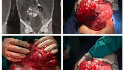 جامعة أسيوط تُعلن عن نجاح فريق طبي في استئصال ورم يزن 8 كجم من بطن طفلة