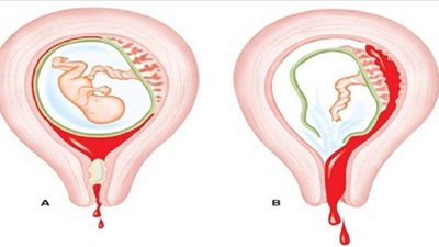 حكم إجهاض الجنين في أول شهرين من الحمل.. ومتى يتم الإجهاض؟.. الإفتاء تجيب