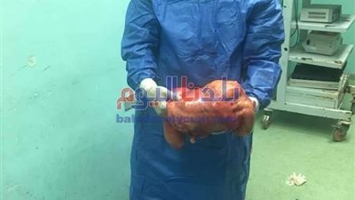 استئصال ورم يزن 15 كيلو من بطن سيدة بمستشفى جامعة المنوفية