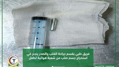 مستشفيات قنا الجامعية تساهم في انقاذ حياة طفلة استنشقت جسم غريب