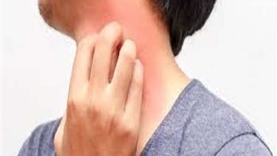 تفشى في تركيا.. أعراض الجرب وكيفية الوقاية منه