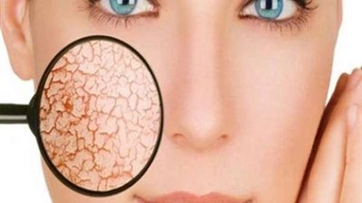 للوقاية من الجفاف.. 4 مكونات طبيعية لترطيب الجلد والحد من التشققات