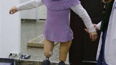 أطراف صناعية بالمجان لذوي الإعاقات الحركية لطلاب المدارس بقنا