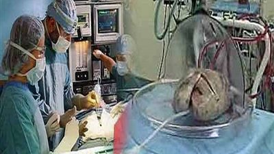 طبيب يطالب بتفعيل زراعة الرئة من المتوفيين في مصر