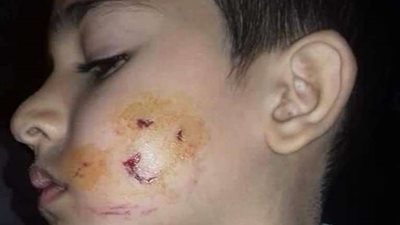 كلب ضال يعقر طفلين في قرية بكفر شكر