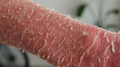 خطأ طبي يحول جلد شاب لمرض نادر أشبه بـ«القشور سمكية» (صور)