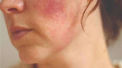 حوار.. خبيرة تجميل تكشف: 5 وصفات للتخلص من تهيج الجلد في الشتاء