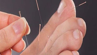 فوائد استخدام الوخز بالإبر في القدم