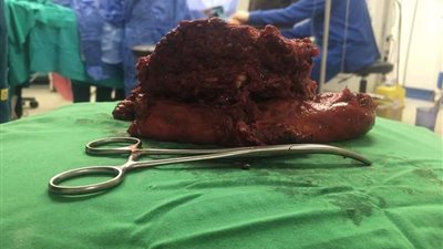 استغرقت 7 ساعات.. إجراء أول جراحة للأورام الخبيثة في مطروح