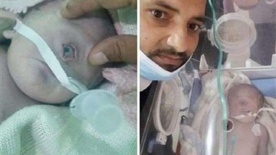 ولادة طفل بعين واحدة يثير الجدل (صور)