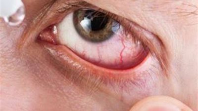 علامات في عينيك قد تدل على الإصابة بمرض السكري