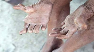 في يومه العالمي.. كل ما تود معرفته عن 