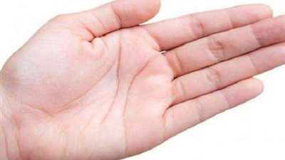 جراحة غريبة.. رجل فقد إبهامه وحصل على 