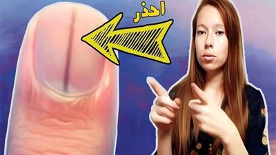 علامة إذا ظهرت تحت أظافرك تدل على وجود ورم سرطاني.. تفاصيل